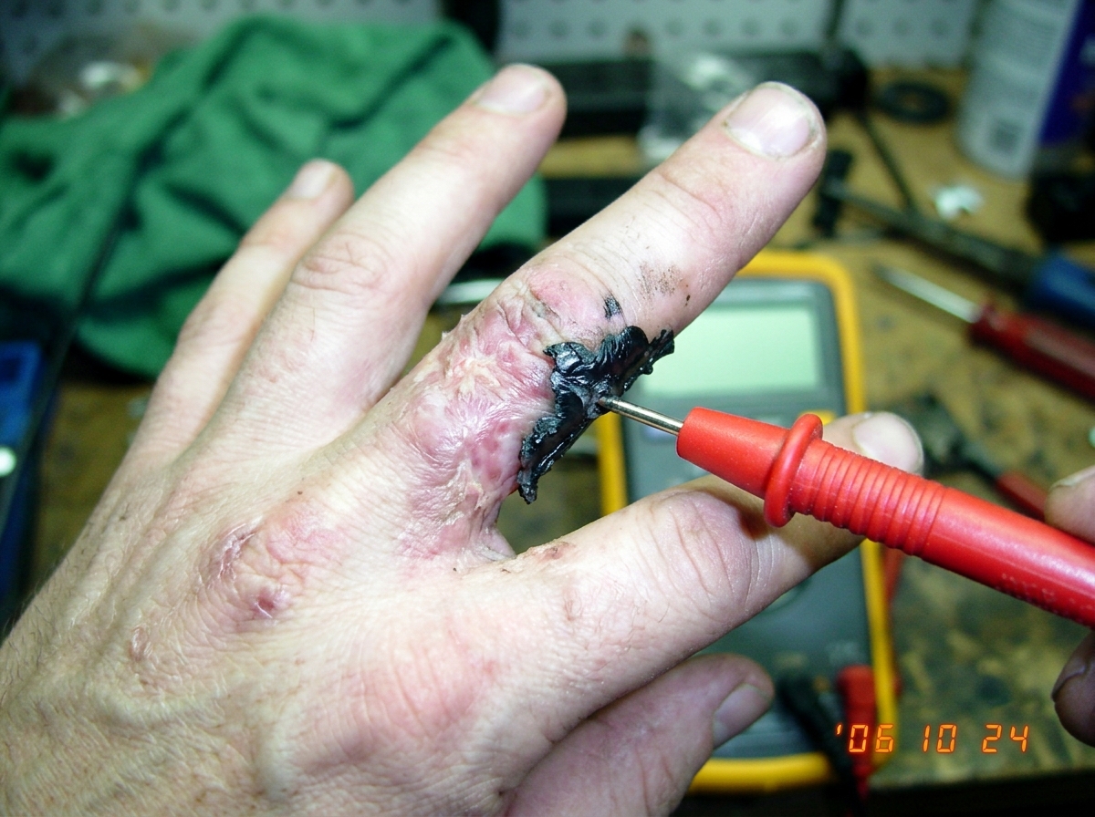 A close-up photo of two fingers fused together by melted plastic and skin scarring, with a multimeter probe touching the joint.